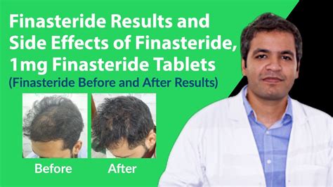 finasteride side effects older men.